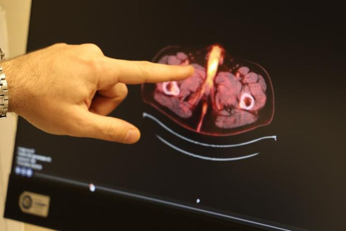 Diyarbakır’da Nadir Görülen Kolon Kanseri Komplikasyonu: Penisin Alınmasıyla Hayat Kalitesi Yükseldi