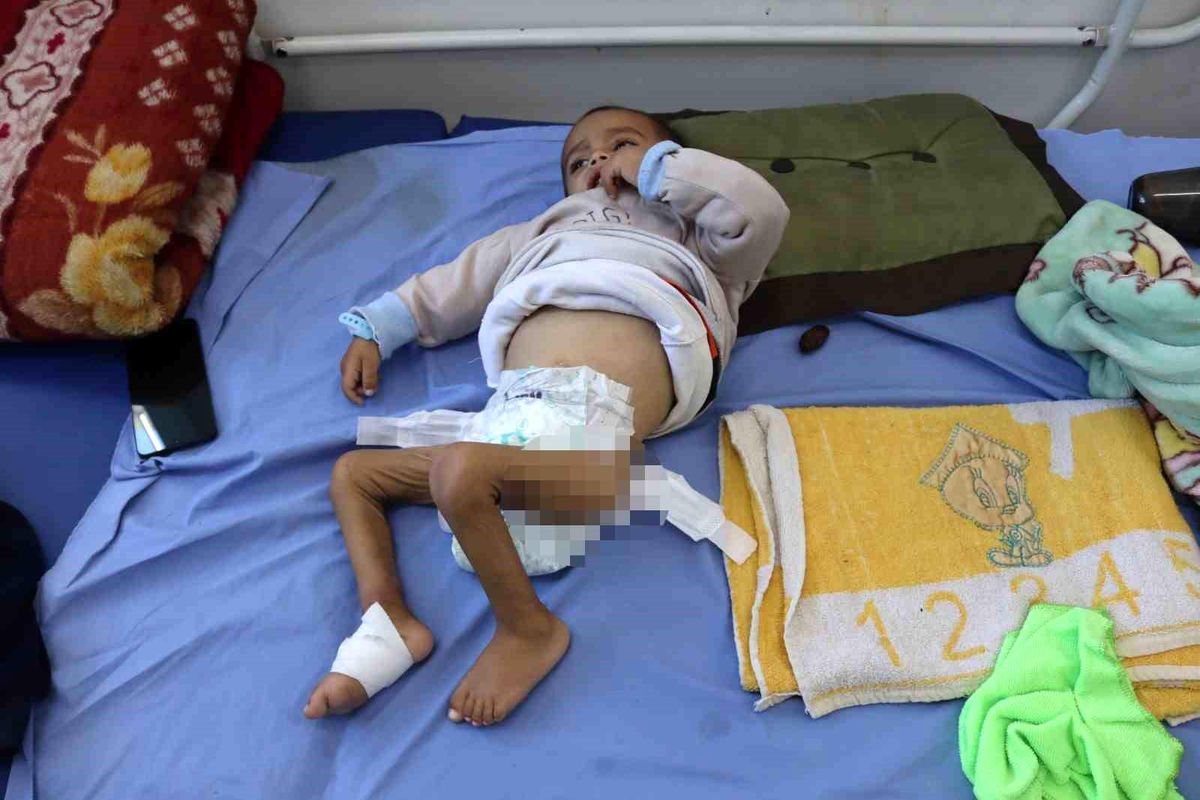 Gazze’de Ateşkes Sonrası Çocuklar Açlık ve Yetersiz Beslenmeyle Mücadele Ediyor